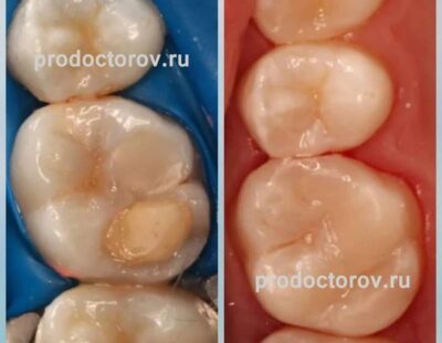 Восстановление функциональности зуба