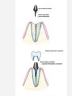 Культевая вкладка при реставрации зуба