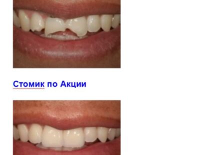 Методы реставрации зубов: прямой и непрямой