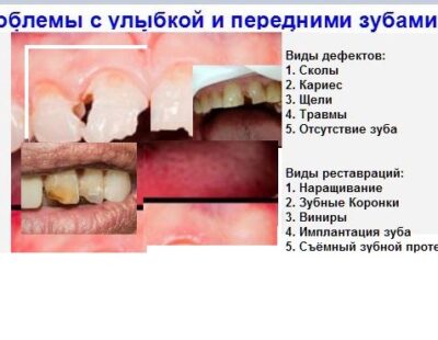 Проблемы с передними зубами которые устраняются с помощью реставрации зубов
