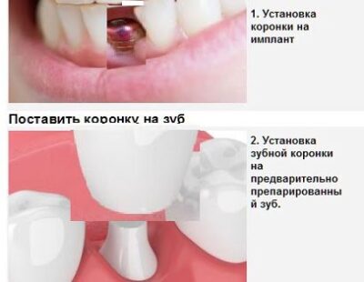 Установки коронки на зуб