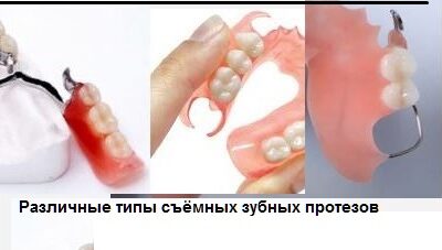 Съёмные зубные протезы