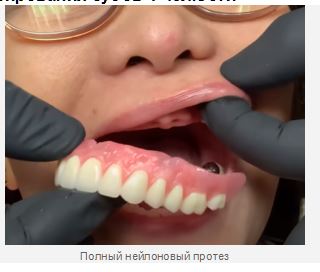 Съёмные полные зубные протезы 