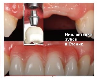 имплантация зубов - способ вставить зуб (Автор Туров Д.В,)