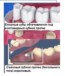 Протезирование зубов съёмными и несъёмными зубными протезами