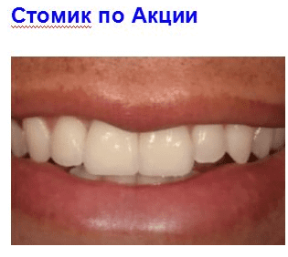 Стоимость реставрации зубов по Акции