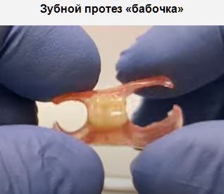 Зубной протез бабочка