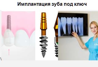 Имплантация зуба под ключ цены в Калининграде