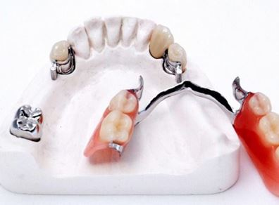 Зубной протез бюгельного типа крепления