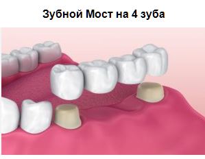 Зубной мост на 4 зуба
