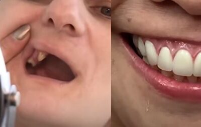 Протезирование зубов "До и После"