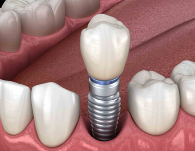 Имплантация переднего зуба под ключ