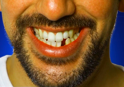 Реальны отзывы и история успеха при имплантации зубов